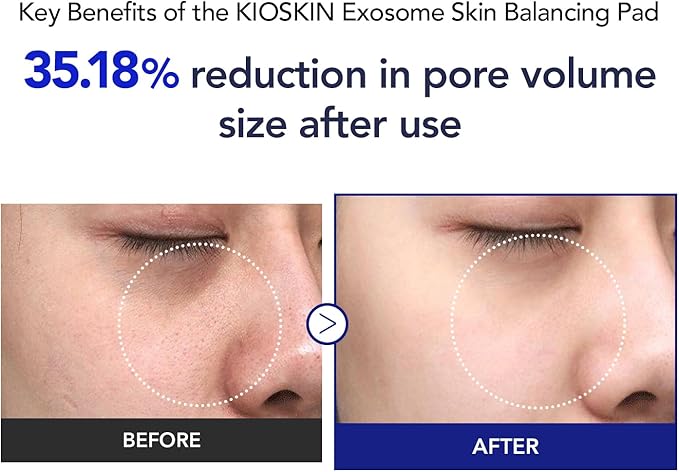 35% Smaller Pores & 32% Reduced Pore Area – Improves Skin Texture by 8% – Soothes, Hydrates & Brightens with CICA Exosomes, AHA/BHA/PHA & Fruit Enzymes – Korean Skincare Favorite Toner Pad Kioskin