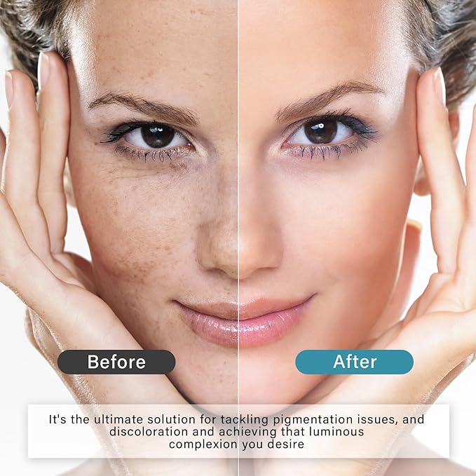 Tranḛxamic Acid 10% Serum, Discoloration Correcting Serum, Face Lotion with Moisturizing Effect, Natural Formula for Skincare