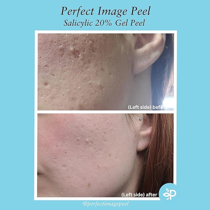 Salicylic Gel Chemical Peel - Enhanced with Green Tea Extract and Tea Tree Oil (20% Strength)